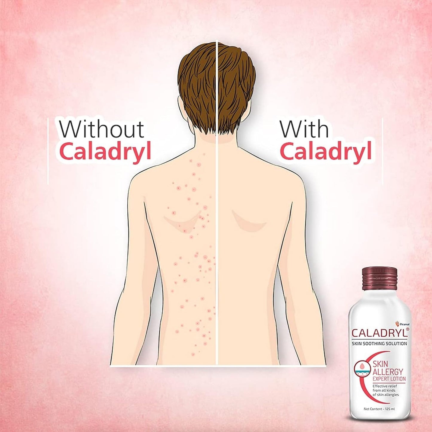 Caladryl Skin Allergy Expert Lotion for relief from skin rashes, sunburn, prickly heat, insect bites (125 ml)